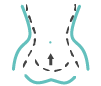 Reconstrucción abdominal Reconstrucción abdominal